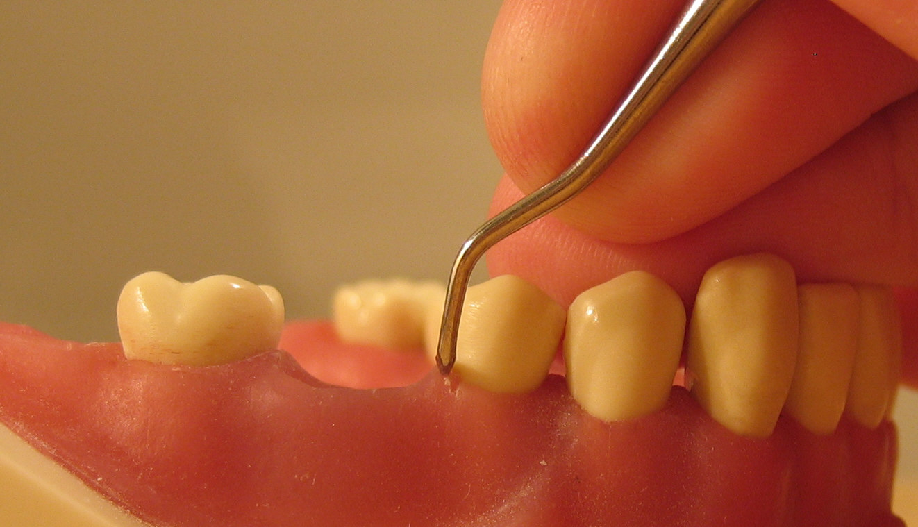 Posterior scaler on teeth